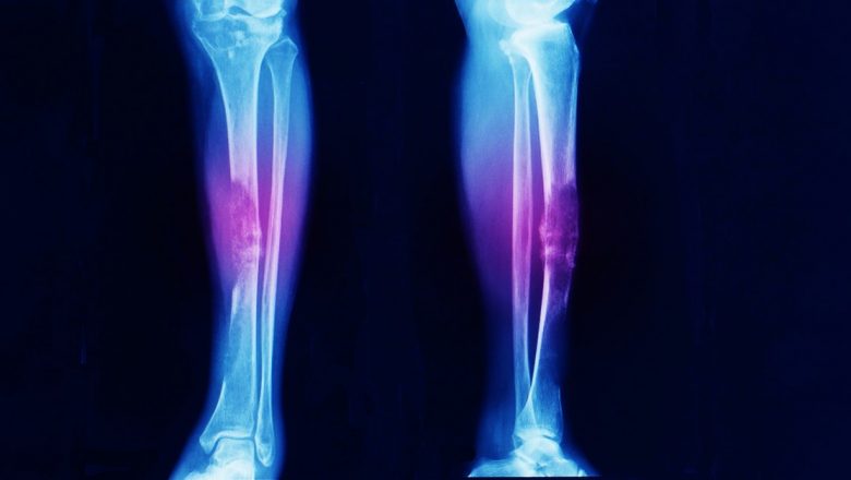 Simptomele precoce ale cancerului osos: Importanța diagnosticării corecte și impactul asupra pacienților