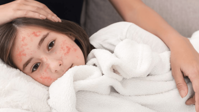 Epidemie de Rujeolă în România: Cauze, Simptome și Implicații pe Termen Lung