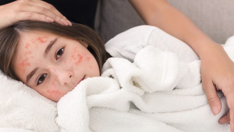 Epidemia de rujeolă în România: măsuri urgente și implicații pe termen lung