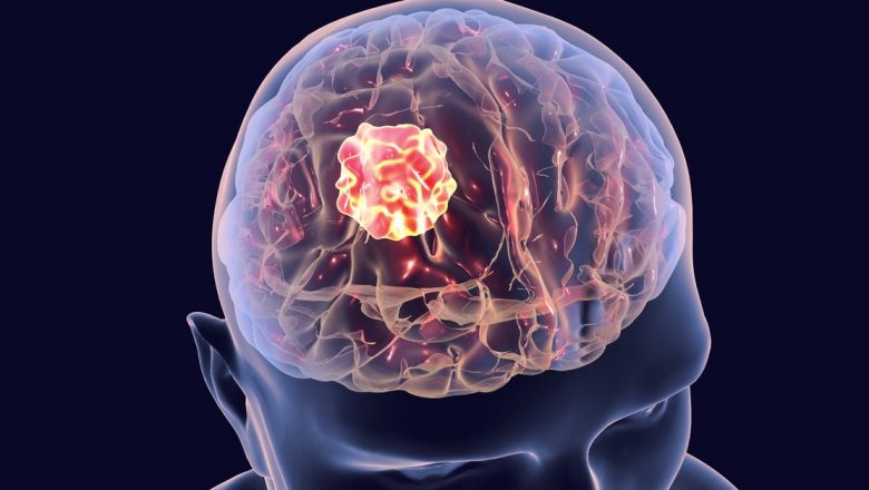 Semnele de avertizare ale tumorilor cerebrale: când o durere de cap devine un motiv de îngrijorare