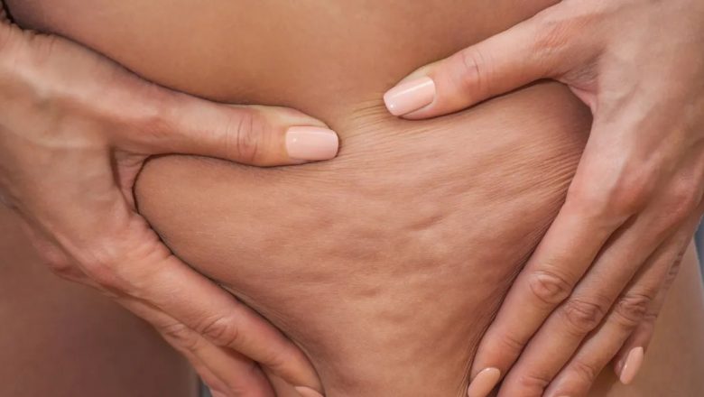 Alimentele care ajută la combaterea celulitei: Ghidul complet pentru o piele netedă și fermă