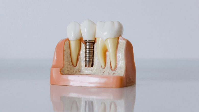 Implanturi dentare: Reînnoirea zâmbetului și impactul pe termen lung asupra sănătății dentare