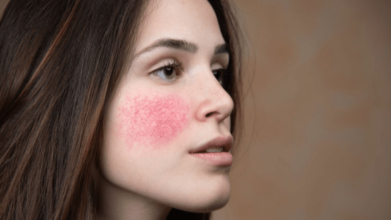 Cuperoza: Cauze, Simptome și Remedii Naturale Eficiente pentru Ameliorare