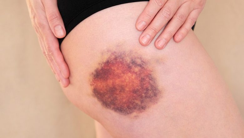 Când vânătăile de pe corp pot indica cancer: Semne, cauze și implicatii
