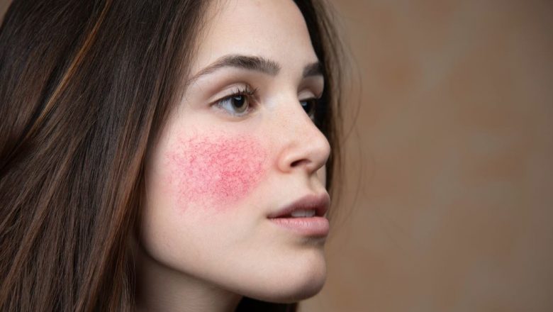 Cuperoza: Cauze, Simptome și Remedii Naturale pentru Îngrijirea Pielii