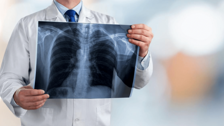 Cancerul bronhopulmonar la bărbații din România: O analiză profundă a provocărilor și soluțiilor