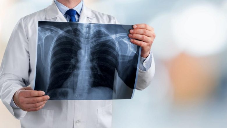 Cancerul pulmonar la bărbații din România: O privire detaliată asupra tratamentului și provocărilor