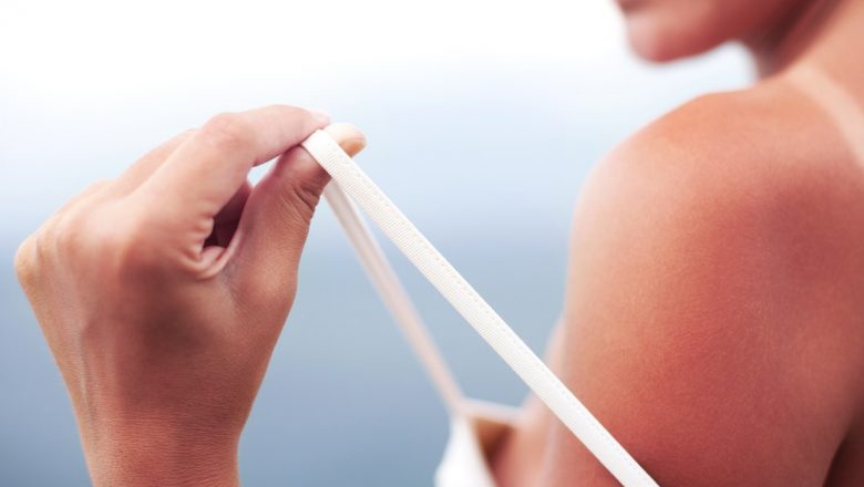Ghid complet pentru prevenția și tratamentul arsurilor solare: sfaturi esențiale de la experți