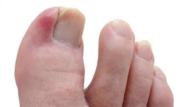Remedii Naturale pentru Unghiile Încarnate: Ghid Complet pentru Sănătatea Piciorului