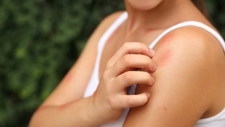 Săpunul Natural: Soluția Eficientă pentru Ameliorarea Durerilor Causate de Înțepăturile de Țânțari