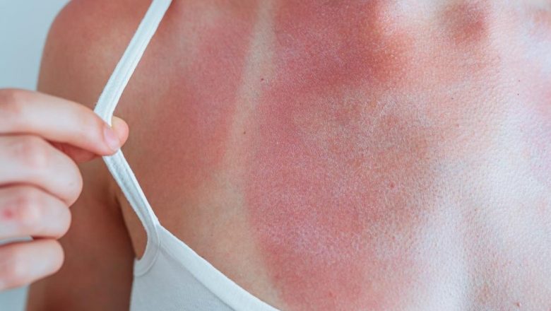 Ghid complet pentru îngrijirea pielii arse de soare: soluții naturale și prevenție