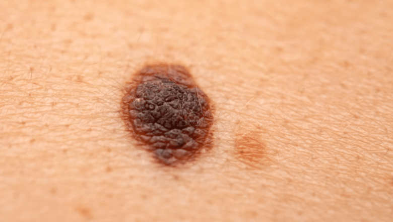 Melanomul: Tot Ce Trebuie Să Știi Despre Cea Mai Gravă Formă de Cancer de Piele