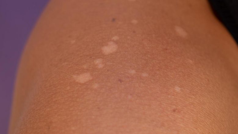 Petele Albe de pe Piele: Cauze, Diagnostice și Implicații pentru Sănătate