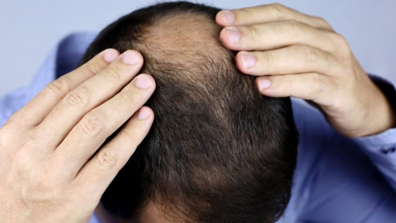Impactul Hidratarei Asupra Căderii Părului: O Analiză Detaliată