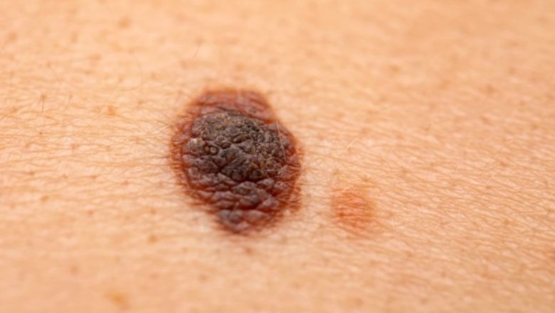 Melanomul: Recunoașterea, prevenția și tratamentele acestei forme grave de cancer de piele