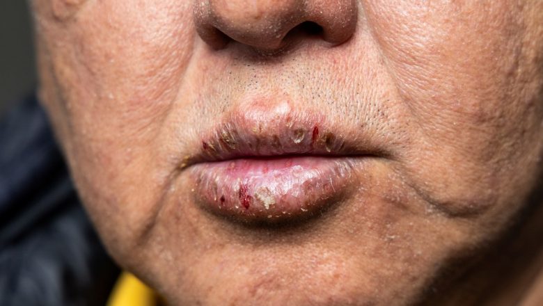 Semnele cancerului de piele: De la buze crăpate la decolorarea unghiilor