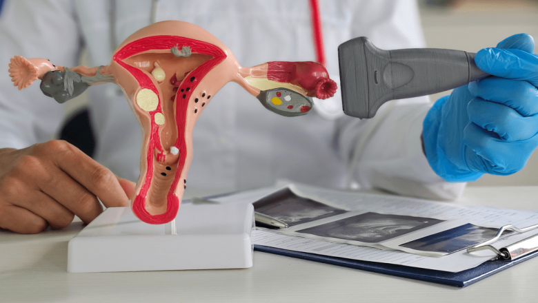 Sindromul Ovarian Polichistic: O Provocare Medicală și Emoțională în Căutarea Greutății Optime