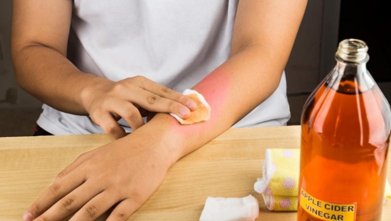Remedii Naturale Eficiente pentru Îndepărtarea Negilor: O Analiză Detaliată