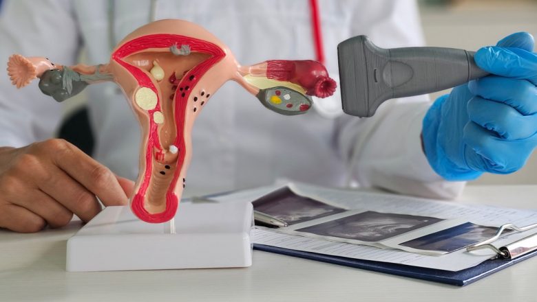 Sindromul Ovarian Polichistic: O Privire Detaliată asupra Impactului și Gestionării Sale