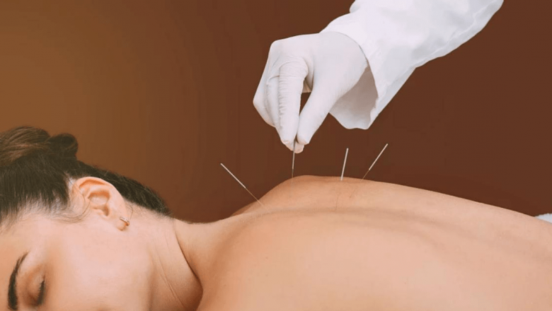 Descoperirea Beneficiilor Ascunse ale Acupuncturii: O Privire Detaliată Asupra Efectelor Sale Asupra Sănătății
