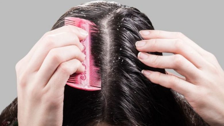 Remedii Naturale Eficiente pentru Combaterea Mătreții: Soluții Simples și Accesibile la Domiciliu