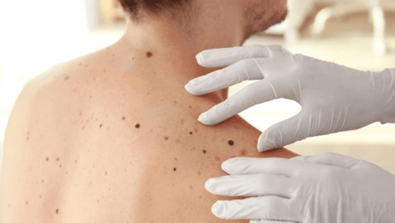 Alunițele: Câte sunt normale și cum putem preveni riscurile de cancer de piele?