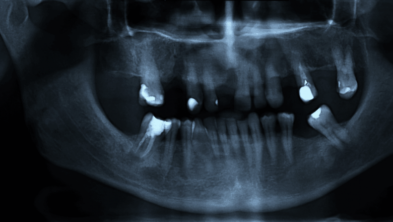 Radiografiile dentare: necesitate medicală sau presiune economică?