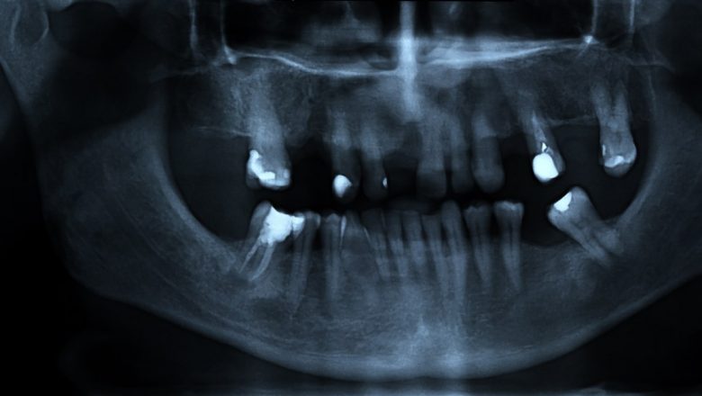 Riscurile și Beneficiile Radiografiilor Dentare: O Analiză Detaliată