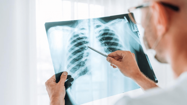 Radiografia toracică: O fereastră către sănătatea plămânilor și inimii