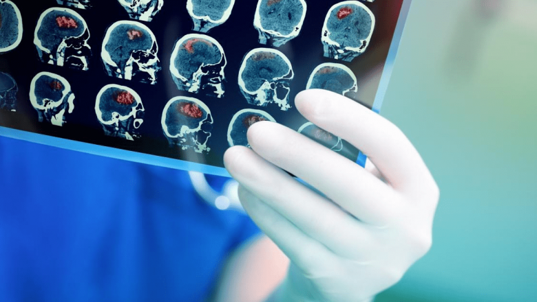 Semnele Accidentului Vascular Cerebral: Ce Trebuie Să Știm pentru a Ne Salva Viața