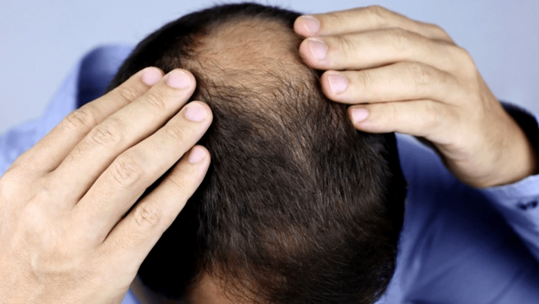 Alopecia: Cauze, soluții și perspectivele viitorului în tratamentele pentru căderea părului