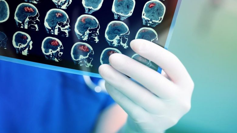 Semnele Accidentului Vascular Cerebral: Ghid detaliat pentru recunoașterea și intervenția rapidă