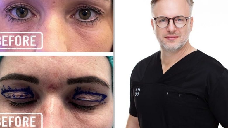 Blefaroplastia: Tot ce trebuie să știi despre operație, costuri și recuperare