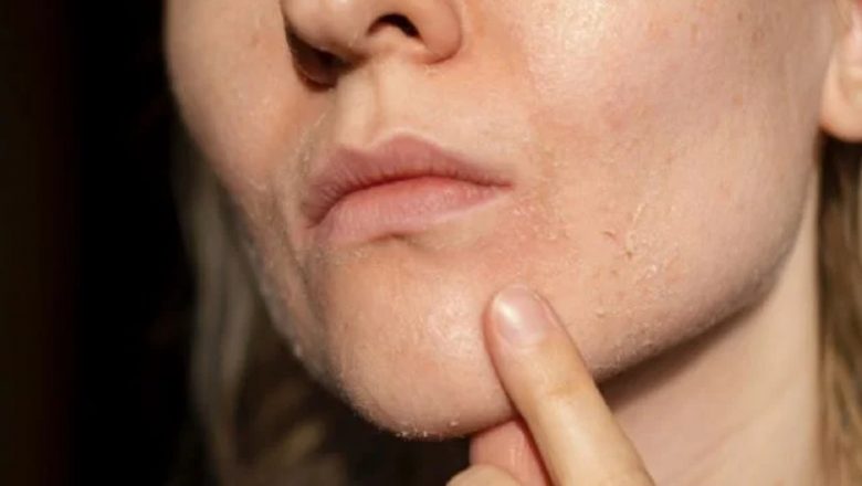 Apa de Orez: Remediul Natural pentru Pielea Uscată în Sezonul Frigului