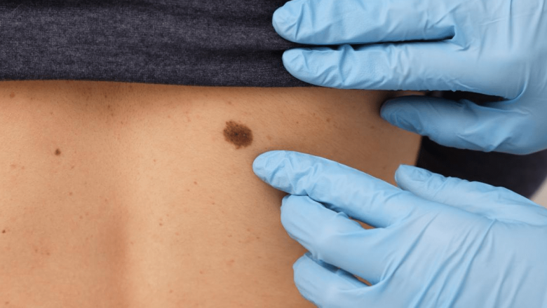 Cancerul de piele: O privire detaliată asupra localizărilor neașteptate și importanței examinării dermatologice