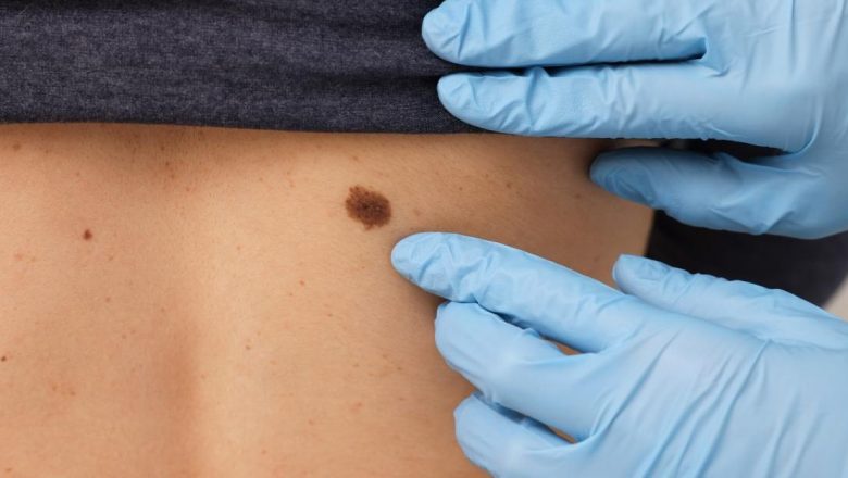 Cancerul de piele: Pericole ascunse și importanța examinării complete
