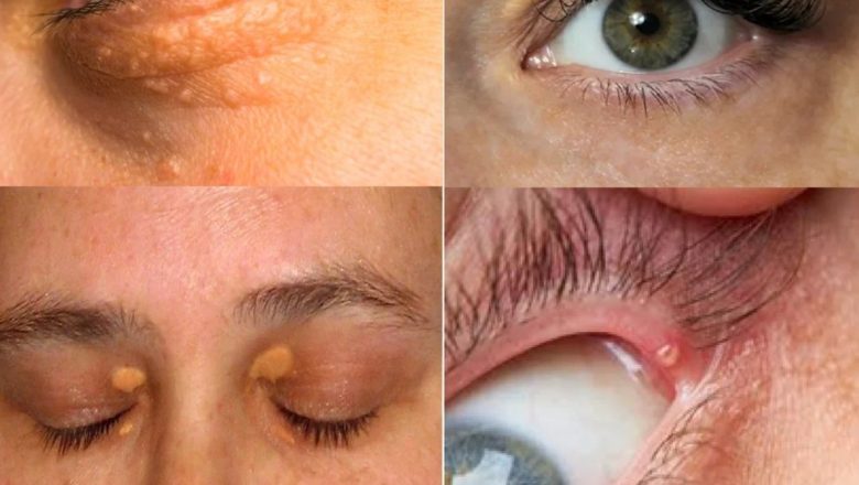 Pericolele ascunse ale colesterolului ridicat: De la xantelasmă la riscuri cardiovasculare