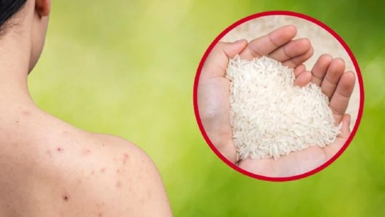 Îngrijirea pielii: Cum să scapi de coșurile de pe spate cu o cremă naturală preparată acasă