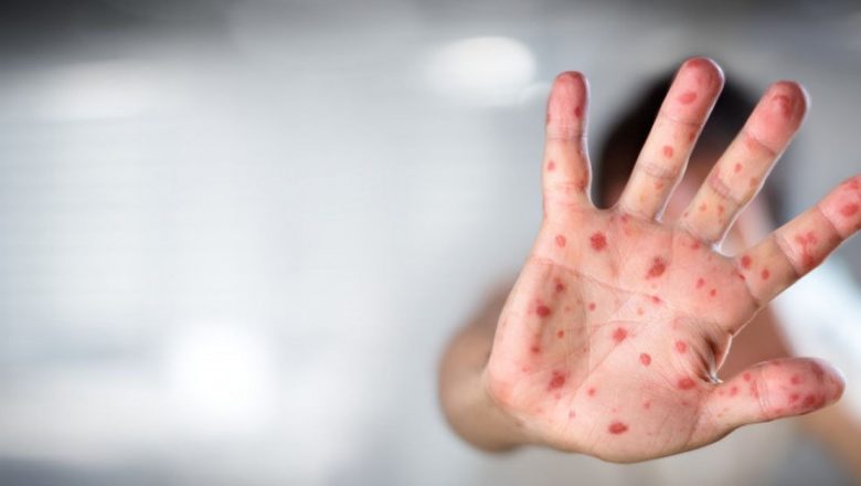 Epidemia de Rujeolă în România: O Criză de Sănătate Publică cu Implicații Profunde