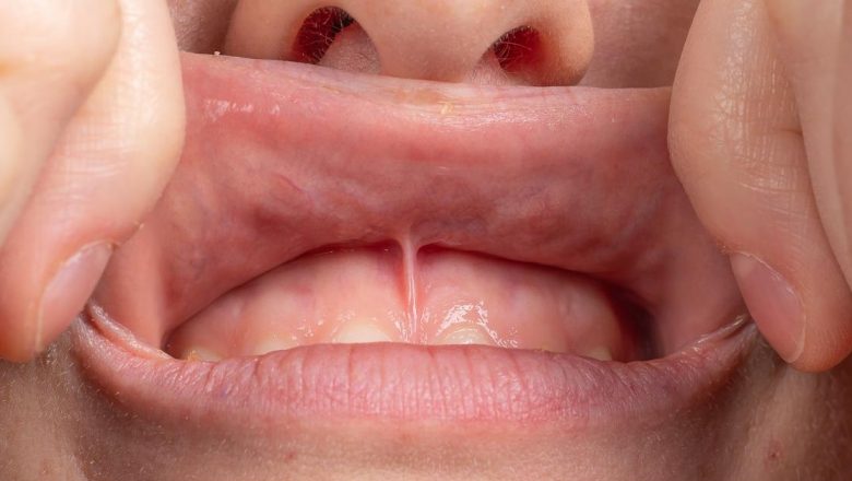 Frenectomia: O Necesitate Subestimată în Dezvoltarea Orală a Copiilor