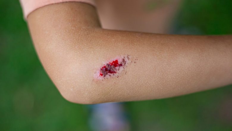 Ghid Complet pentru Îngrijirea Rănilor Acasă: Când și Cum Să Ceri Ajutor Medical