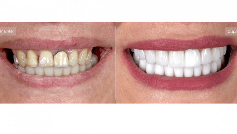 Transformarea prin Implant Dentar: Povestea Emoționantă a Cristinei și Implicațiile Sale