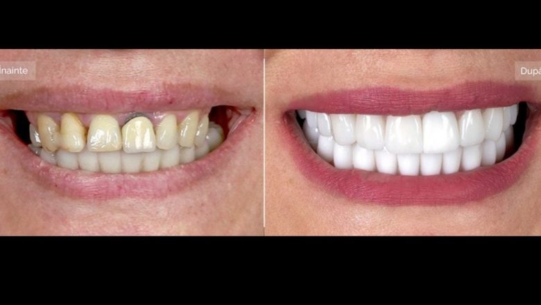 Transformarea prin Implant Dentar: Povestea Cristinei și Impactul Asupra Vieții Sale