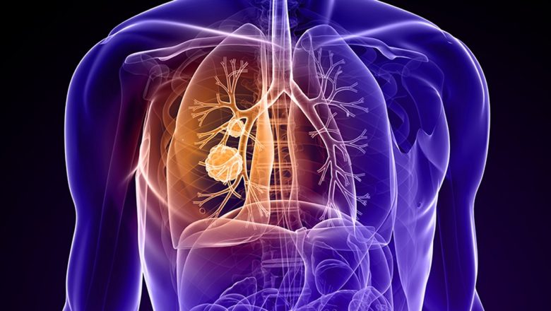 Cancerul Pulmonar: Semne, Cauze și Implicații în Contextul Pierderii lui Ion Iliescu