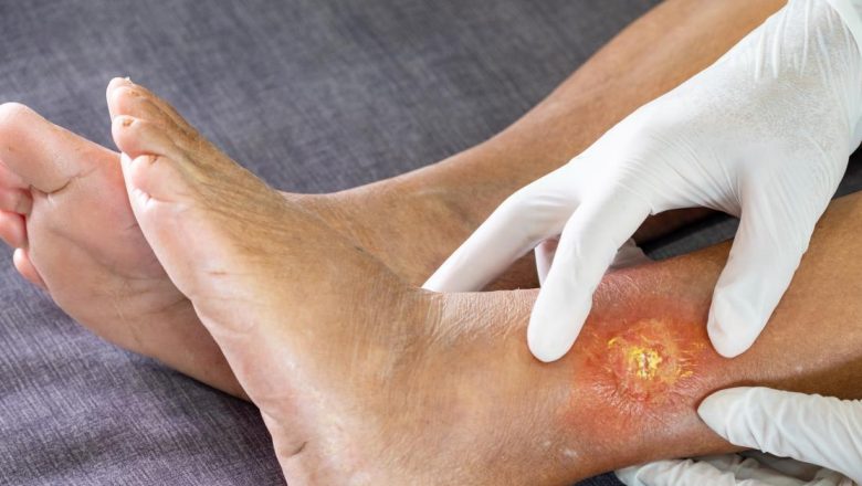 Gangrena: O Afecțiune Periculoasă și Complicațiile Sale Severe