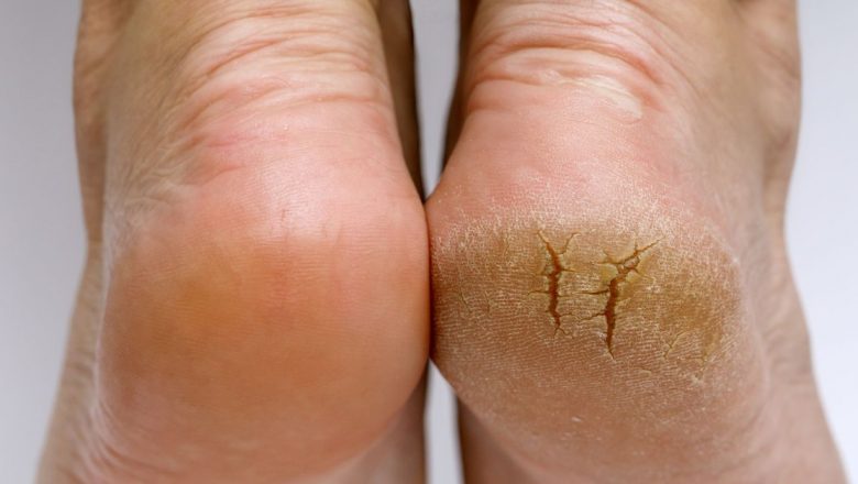 Trucuri esențiale pentru călcâie fine: Cum un ingredient simplu poate transforma aspectul picioarelor tale