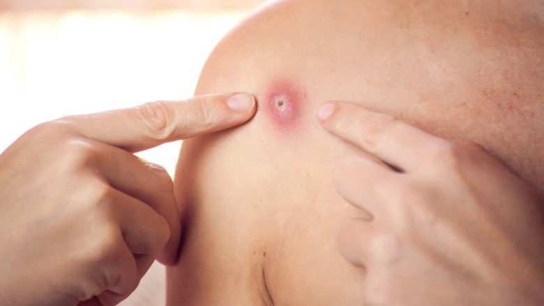 Remedii Naturale pentru Afecțiuni Comune: Unguentul Homemade pentru Hemoroizi, Furuncule, Răni și Arsuri