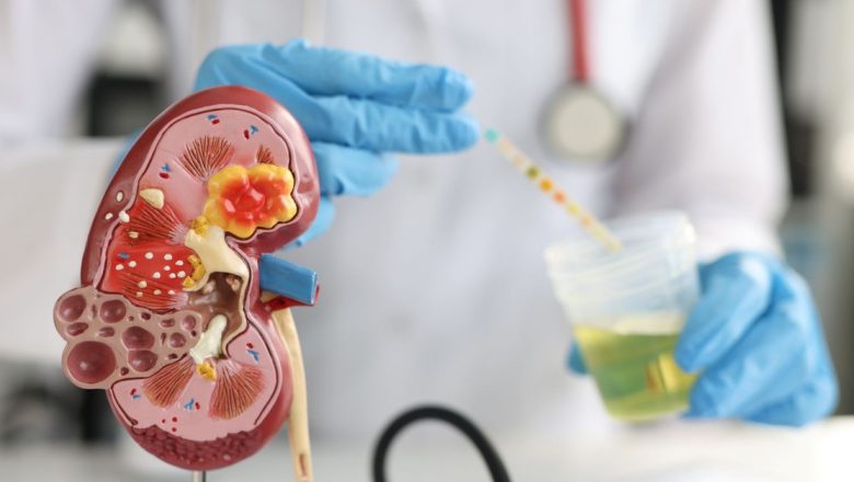 Pietrele la Rinichi și Rolul Alimentației: Ce Trebuie Să Știi pentru a Preveni Această Afecțiune Dureroasă