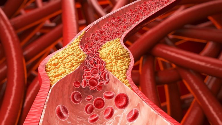 Reducerea colesterolului fără statine: O abordare holistică prin dietă și exerciții fizice