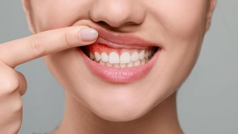Gingiile sângerânde: Un semnal prețios pentru sănătatea inimii